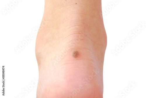 Wart on a person's heel close up