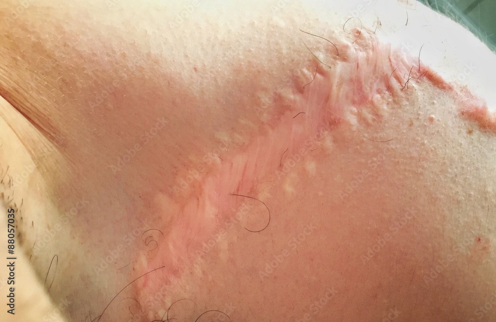 Fototapeta premium Narbe auf einer Schulter