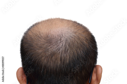 isolated male with hair loss symptoms