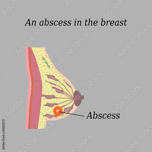 An abscess in the chest. On a gray background. The structure of