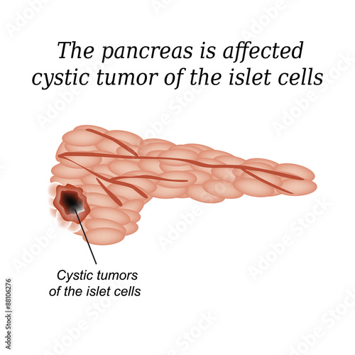 The pancreas is affected cystic tumor of the islet cells