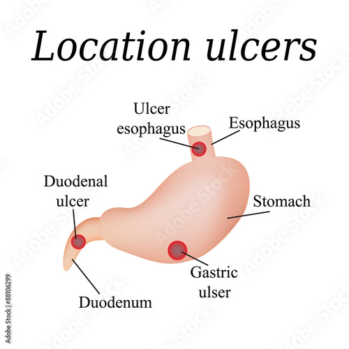 Esophagus ulcer affected. Ulcer of esophagus. Stomach ulcer