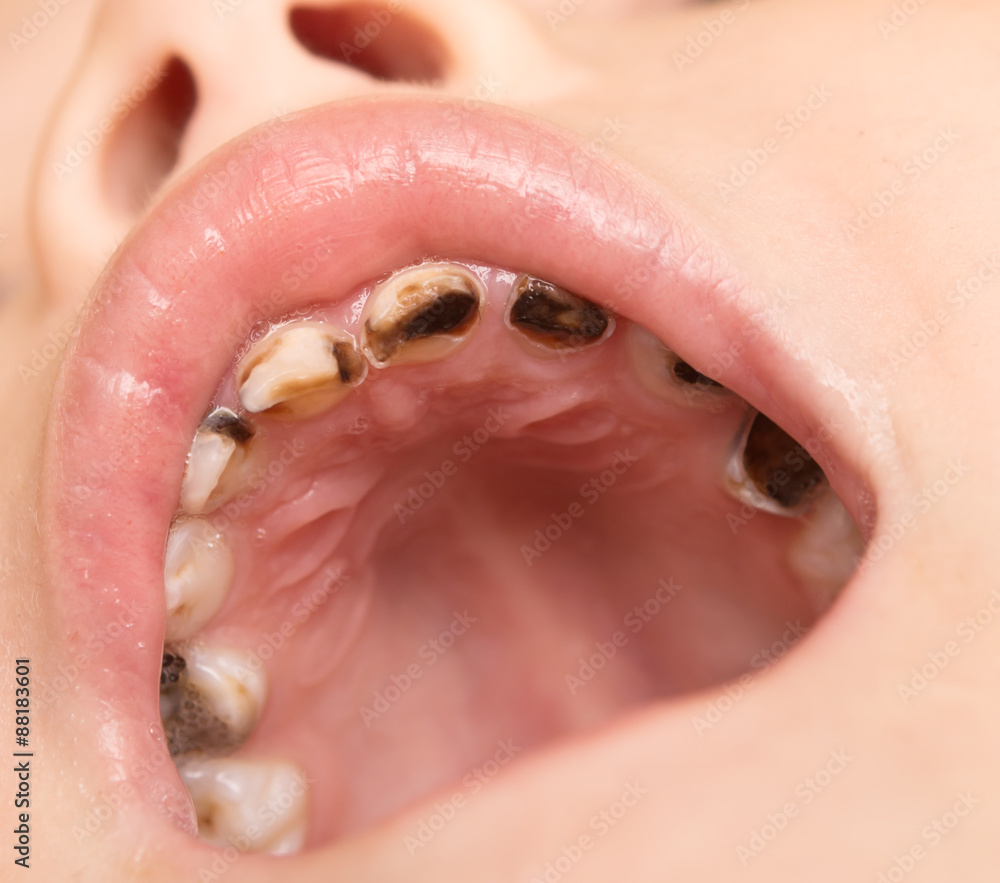 Obraz premium caries