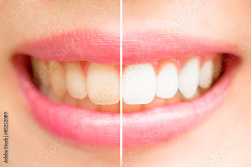 Fotomural Primer plano dientes femeninos entre antes y después de cepillo de los dientes