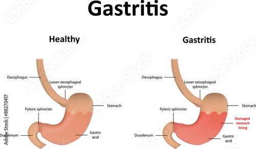 Gastritis Illustration photo