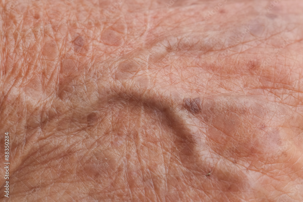 Fototapeta premium old woman skin blood vessel