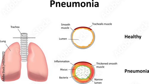 Pneumonia Illustration