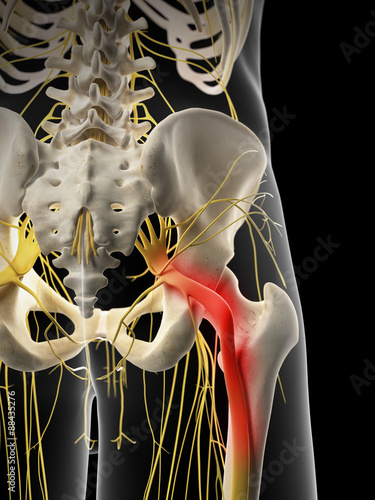 medically accurate illustration - painful sciatic nerve photo