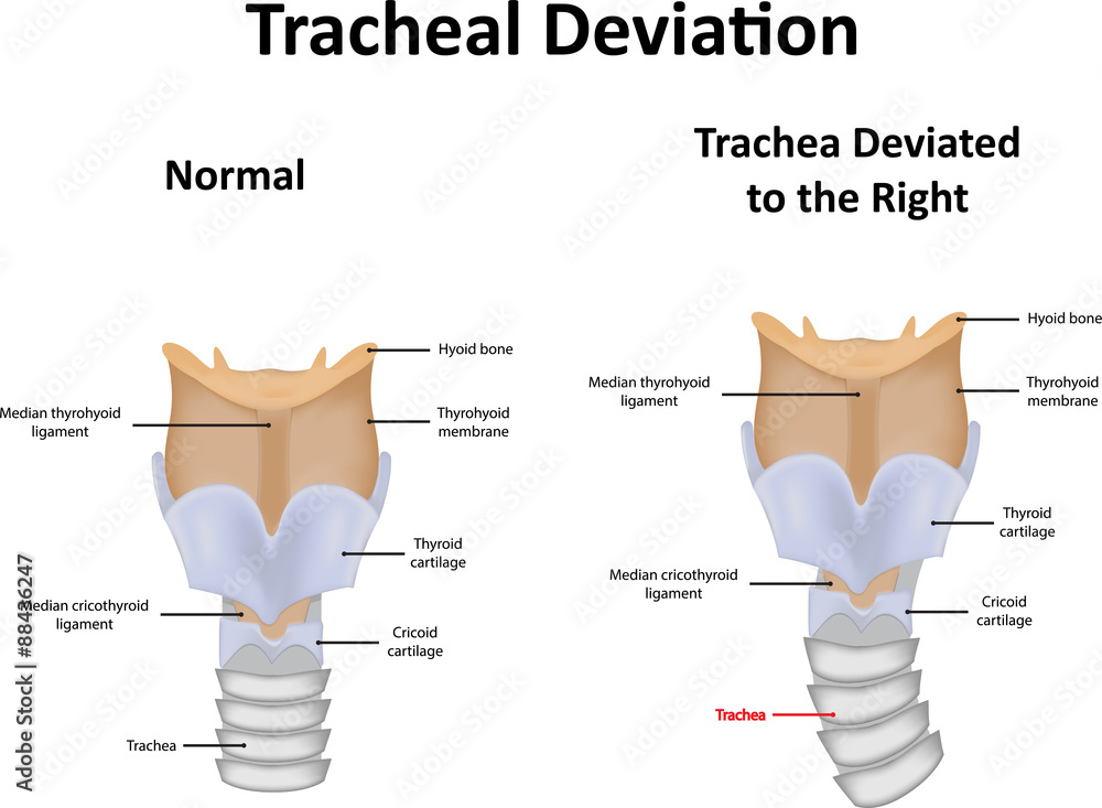 Tracheal Deviation Stock Illustration Adobe Stock