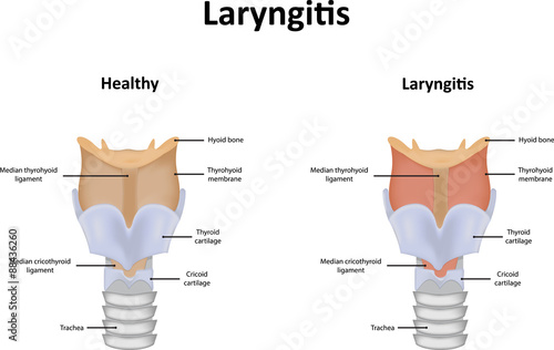 Laryngitis photo