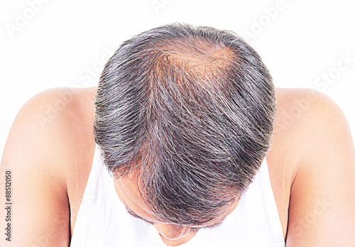 hair loss and grey hair, Male head with hair loss symptoms front