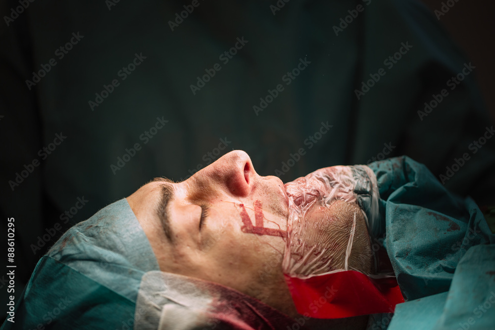 Plastic surgery of the nose in men, rhinoplasty. Plastic surgery of the nose in men, rhinoplasty.