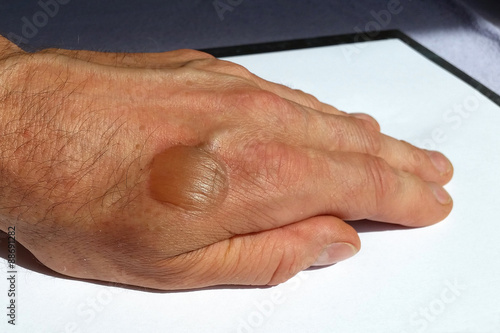 Verbrennung 2. Grades mit Brandblase