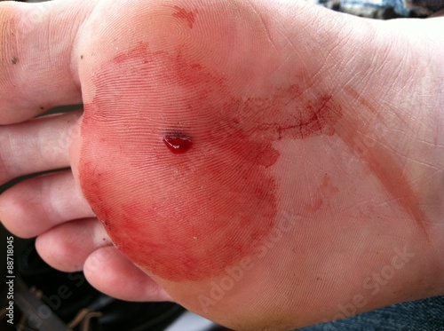 Nail puncture wound