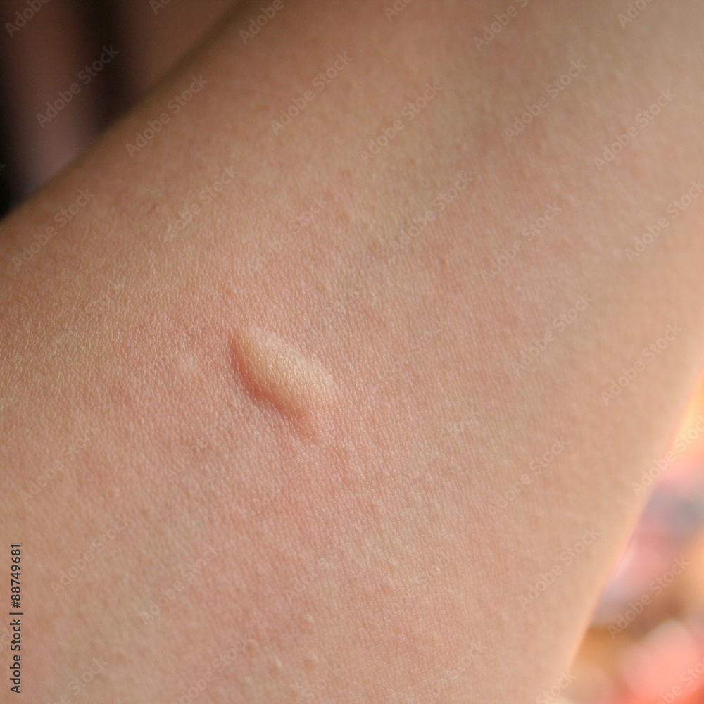 Fototapeta premium puntura di zanzara 