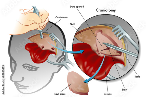 craniotomia