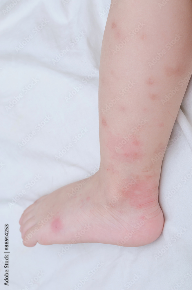 Mosquito Bites Sore On Baby Legs Stock Photo Adobe Stock