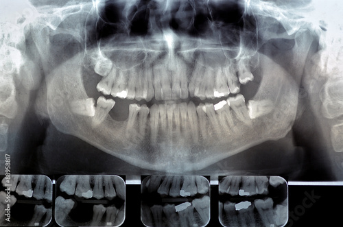 Dental radiography  Digital x-ray teeth scan of adult male photo