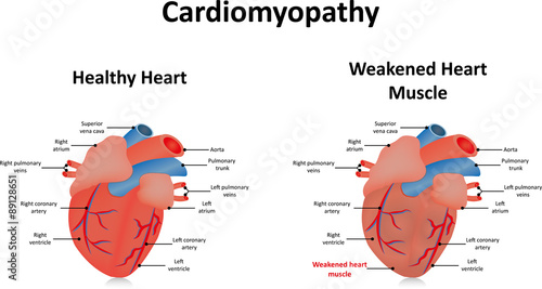Foto Cardiomyopathy Illustration