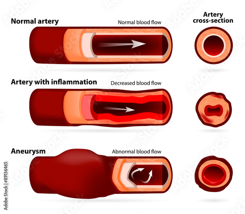 Normal artery, inflamed or narrowed artery and artery with an an