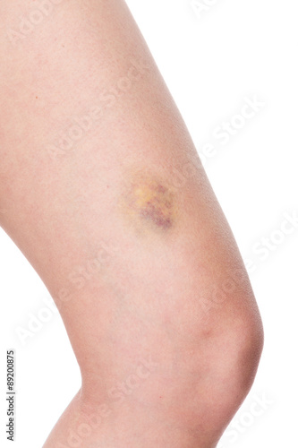 Bruised knee