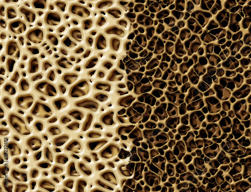 Bone With Osteoperosis