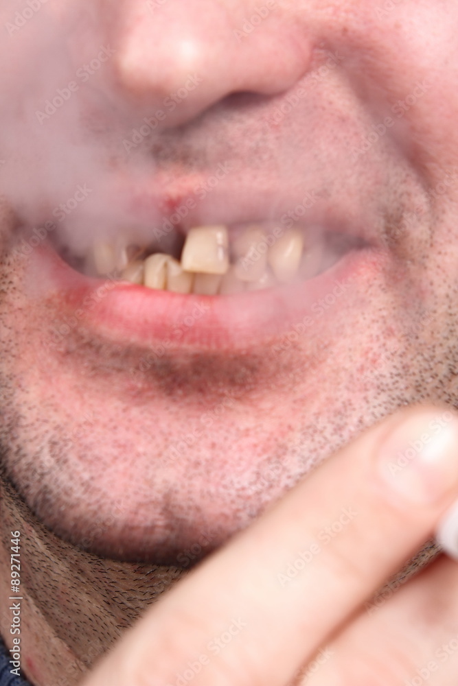 Obraz premium Bad teeth smoker