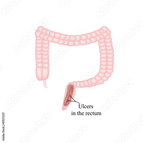 An ulcer in the rectum. Ulcers in the intestines. Vector