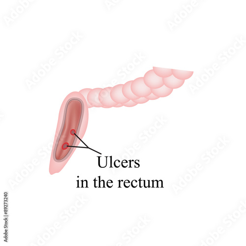 An ulcer in the rectum. Ulcers in the intestines. Vector