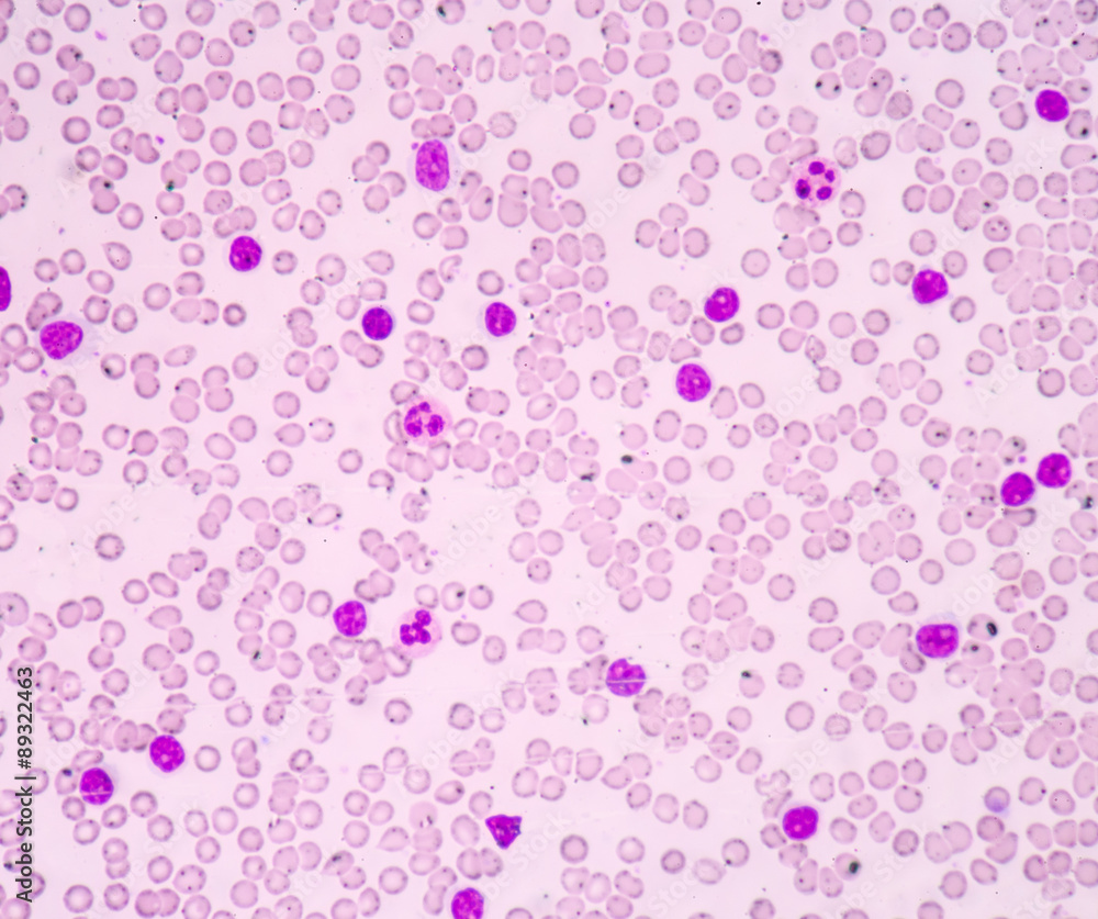 Chronic lymphocytic Leukemia(CLL)