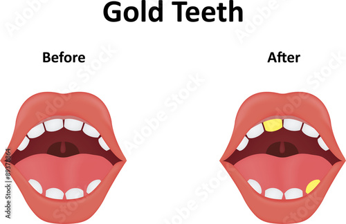 Gold Teeth