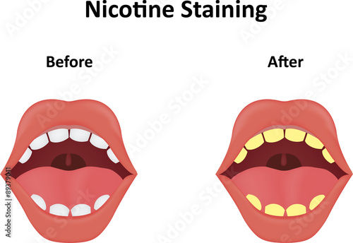 Nicotine Staining