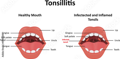 Tonsillitis Illustration