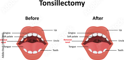 Tonsillectomy Illustration