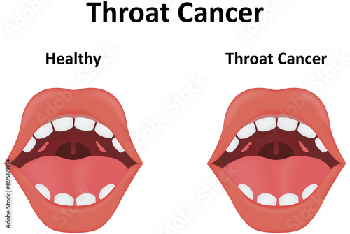 Throat Cancer Illustration