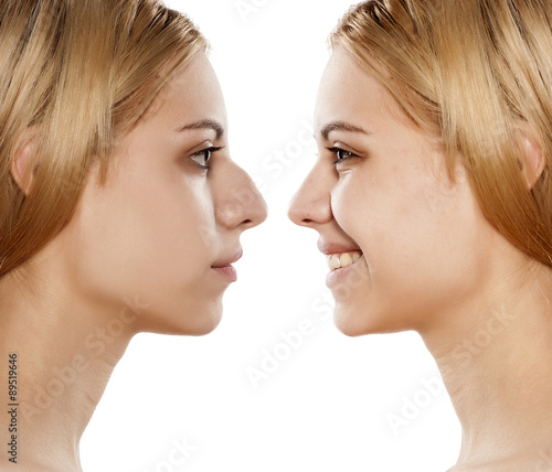 before and after plastic surgery of the nose
