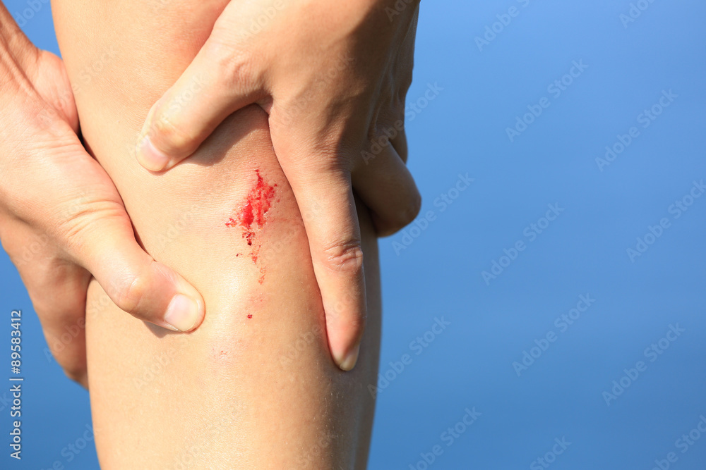 young sporty woman hold her sports injured leg young sporty woman hold her sports injured leg