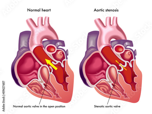 stenosi aortica