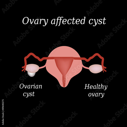 A cyst in the ovary. Pelvic organs. Vector illustration on a