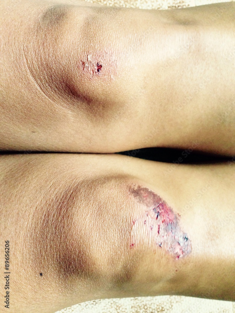 Fototapeta premium wounds on the knees