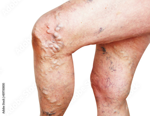 Legs of old woman with varicose veins. photo
