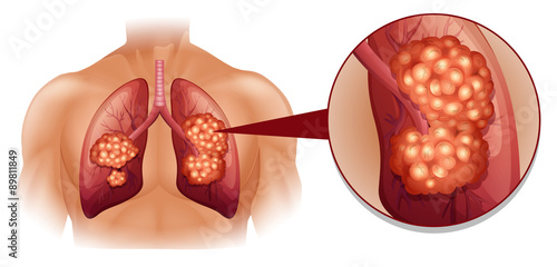 Lung cancer diagram in details