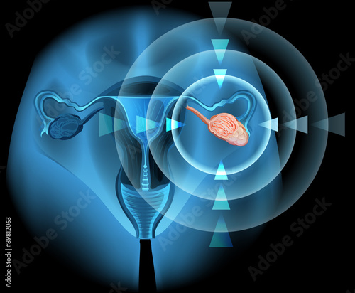 Overian cancer diagram in detail