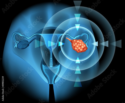 Overian cancer diagram in detail photo