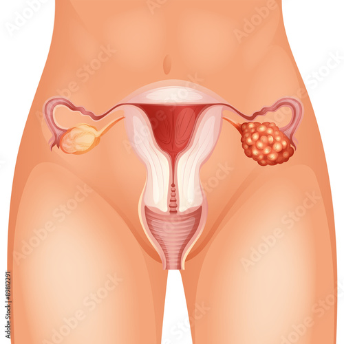 Ovarian cancer diagram in detail