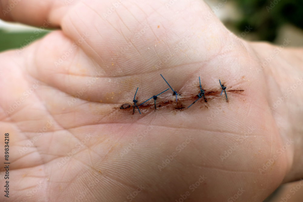 Obraz premium Karpaltunnelsyndrom