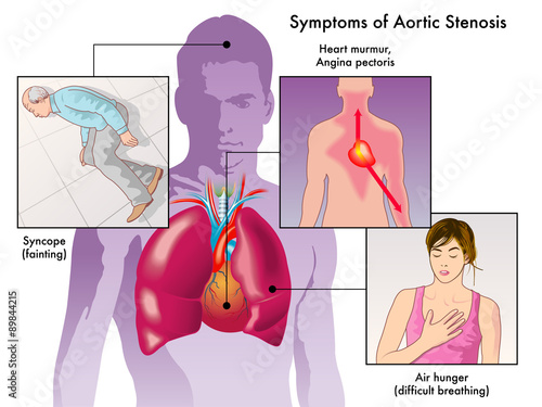 sintomi stenosi aortica photo