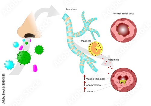inalazione di allergeni e relativa asma