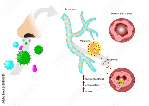 inalazione di allergeni e relativa asma photo