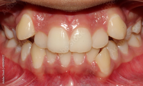 Photos A Child with Crooked teeth